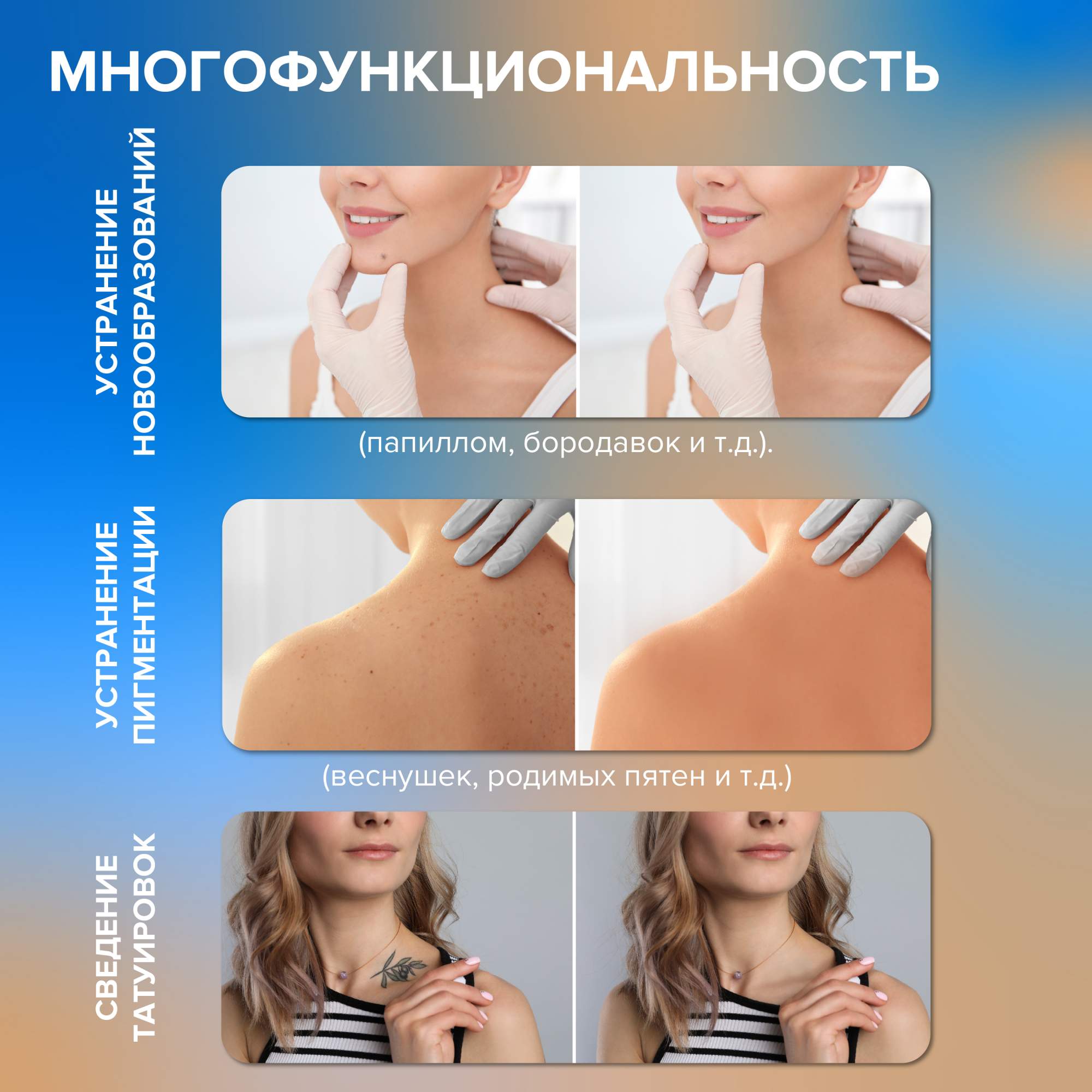 Лазерная ручка Evo Beauty для удаления бородавок, шрамов, угрей, родинок и  тату, белая - отзывы покупателей на Мегамаркет | косметологические  инструменты для чистки лица plasmapen2