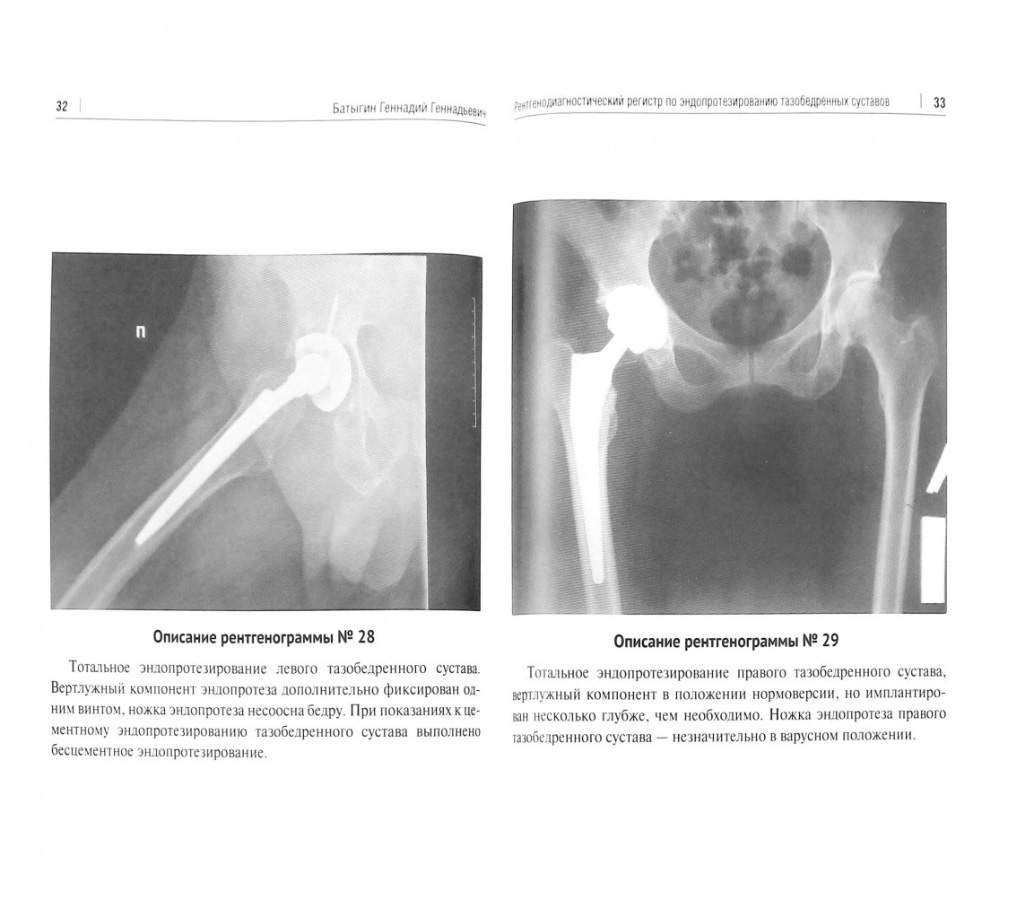 Рентгенологический регистр по эндопротезированию тазобедренных суставов –  купить в Москве, цены в интернет-магазинах на Мегамаркет