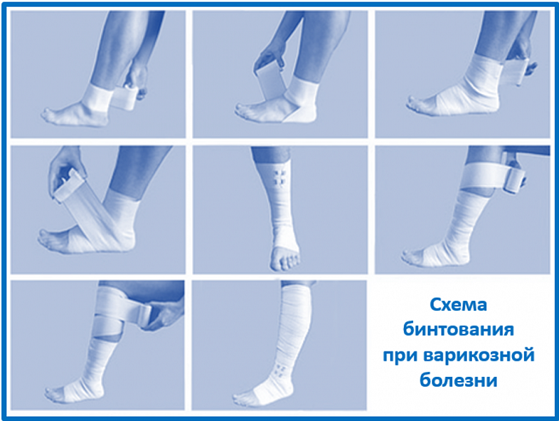 Бинтование ноги компрессионным бинтом. Бинтование нижних конечностей эластичным бинтом алгоритм. Эластичное бинтование склеротерапия. Как правильно бинтовать ногу при варикозе. Бинтование конечности эластичным бинтом алгоритм.