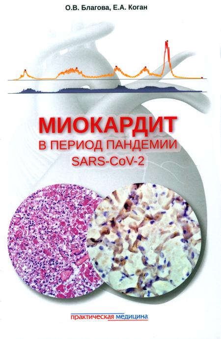 

Миокардит в период пандемии SARS-CoV-2