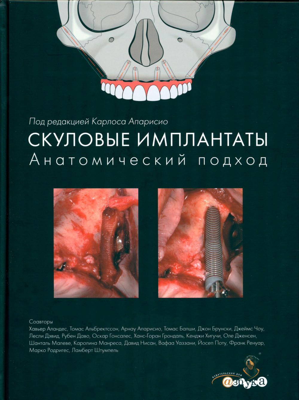 

Скуловые имплантаты. Анатомический подход