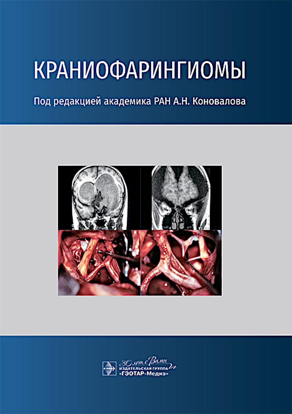 

Краниофарингиомы