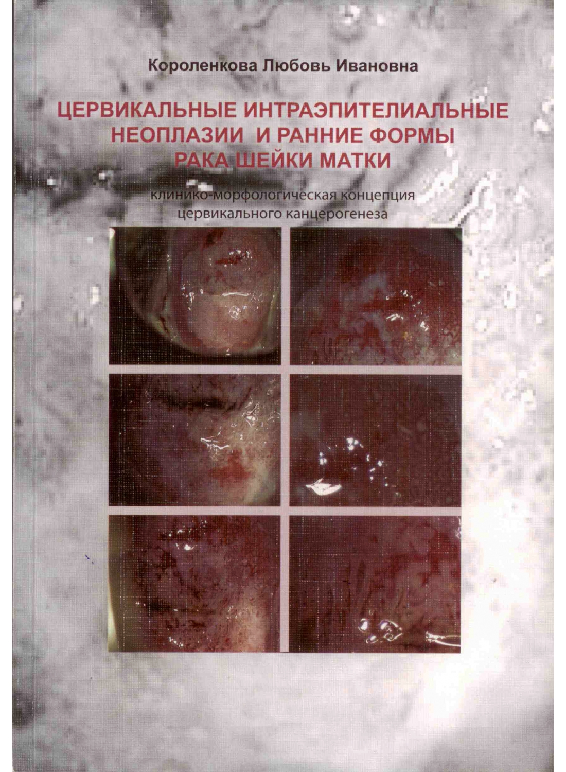 

Цервикальные интраэпителиальные неоплазии и ранние формы рака шейки матки. Клиник...
