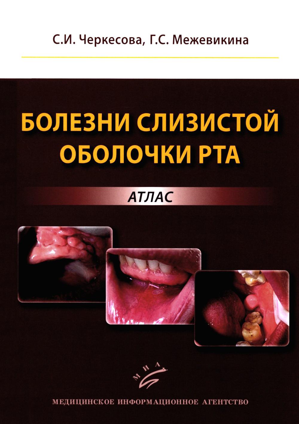 

Болезни слизистой оболочки рта