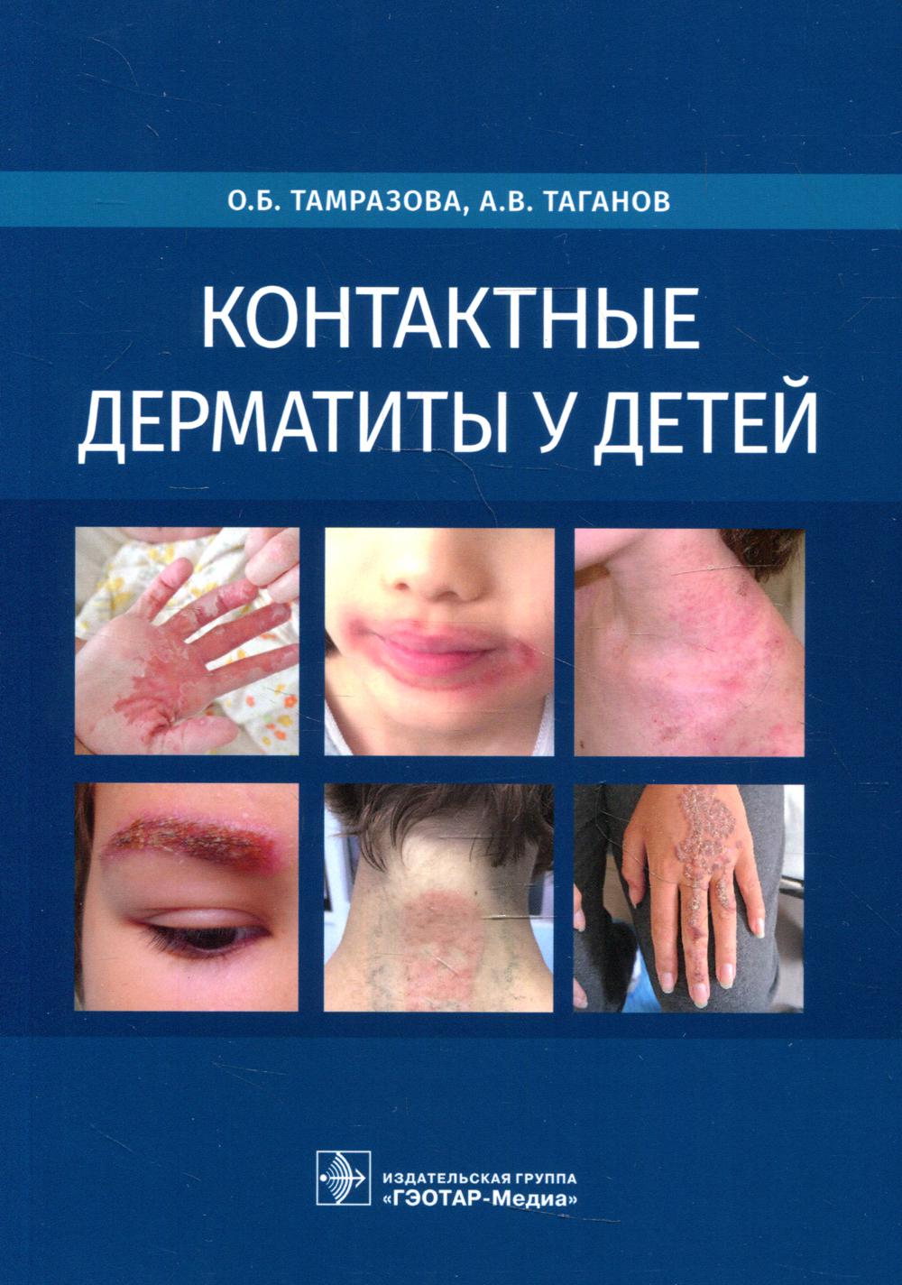 фото Книга контактные дерматиты у детей гэотар-медиа