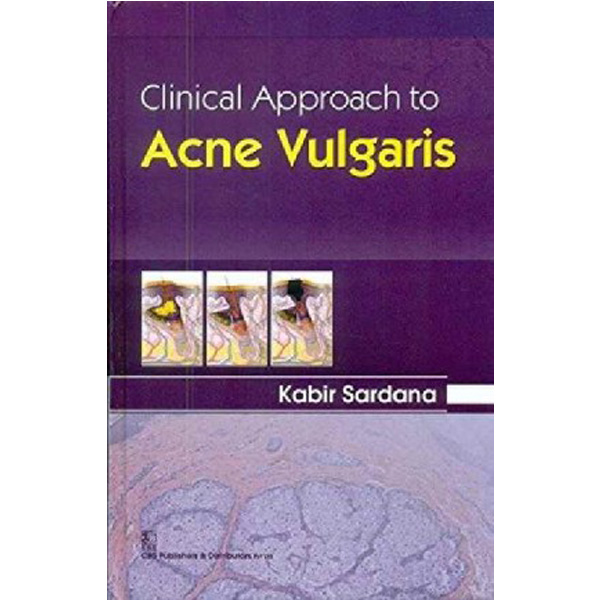 

Clinical approach to acne vulgaris