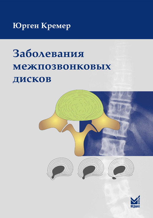 

Заболевания межпозвонковых дисков