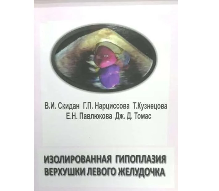 

Изолированная гипоплазия верхушки левого желудочка