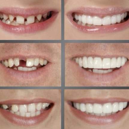 Накладные виниры для зубов Smile Veneers